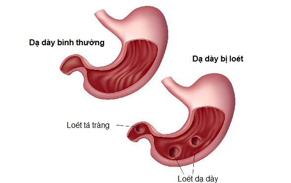 Viêm loét dạ dày khác viêm loét tá tràng