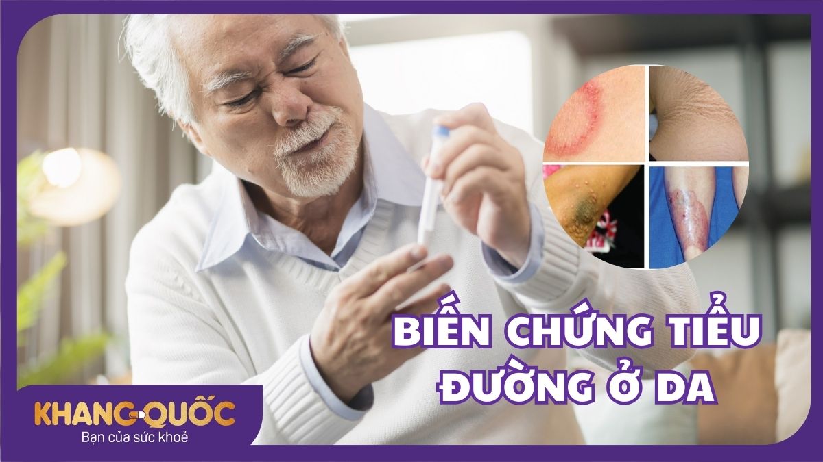 Biến chứng tiểu đường ở da không nên xem nhẹ