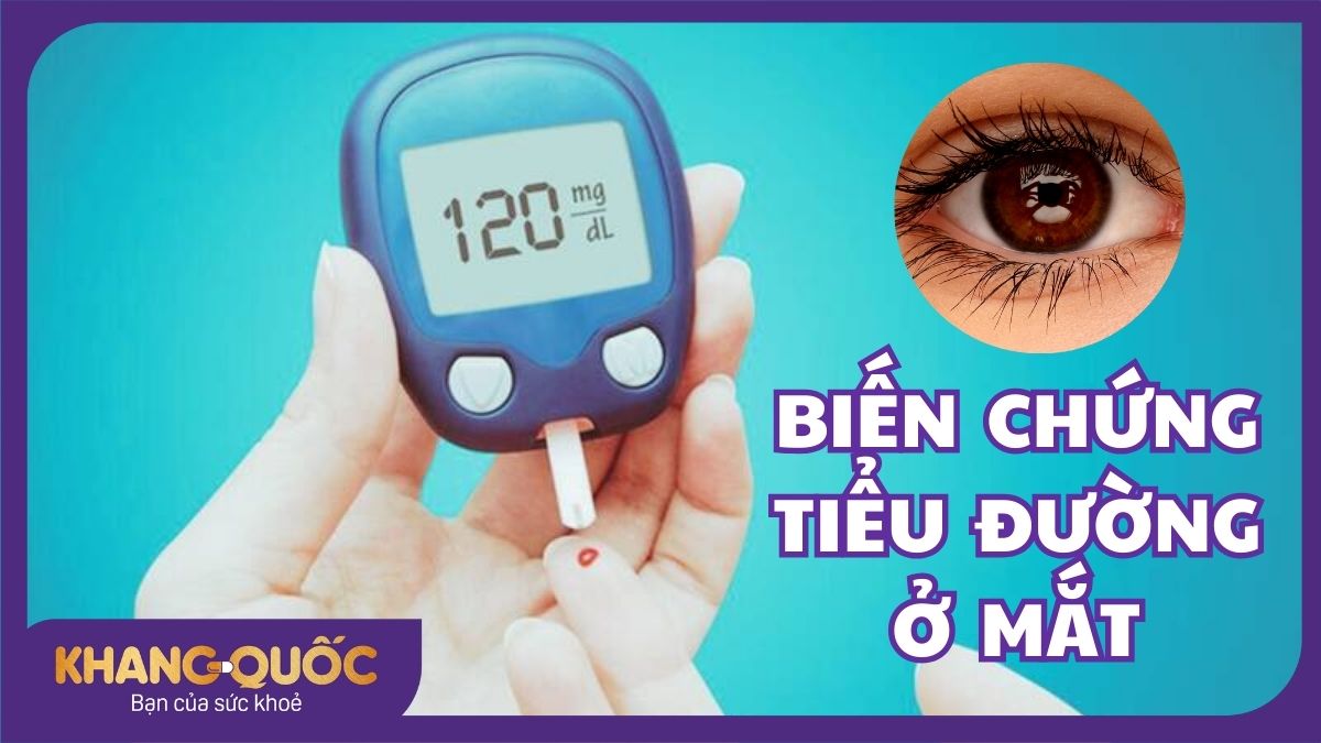 Biến chứng tiểu đường ở mắt và điều cần chú ý