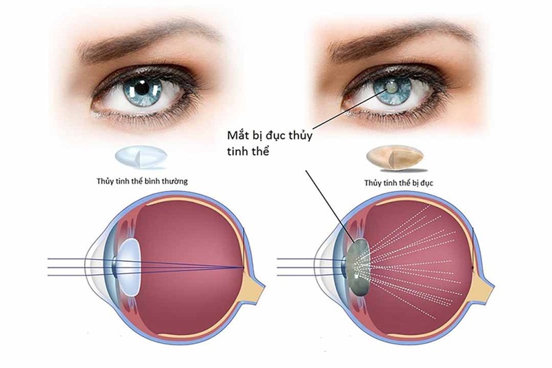 Đái tháo đường gây đục thủy tinh thể