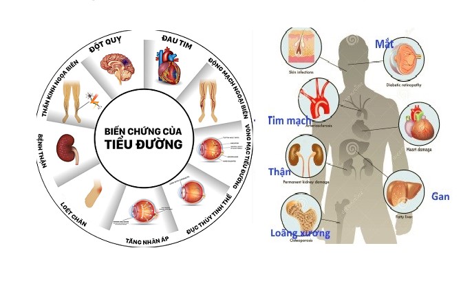 Thời gian biến chứng của đái tháo đường