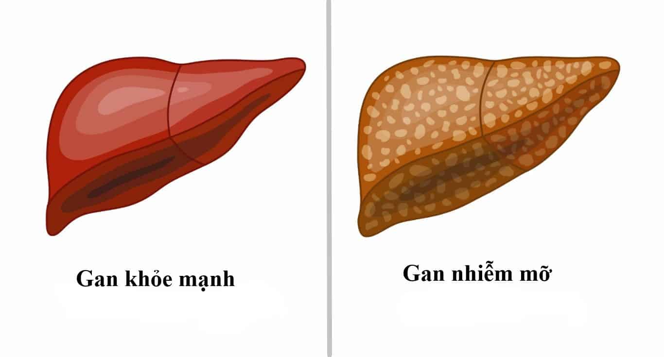 Gan mỡ nhiễm