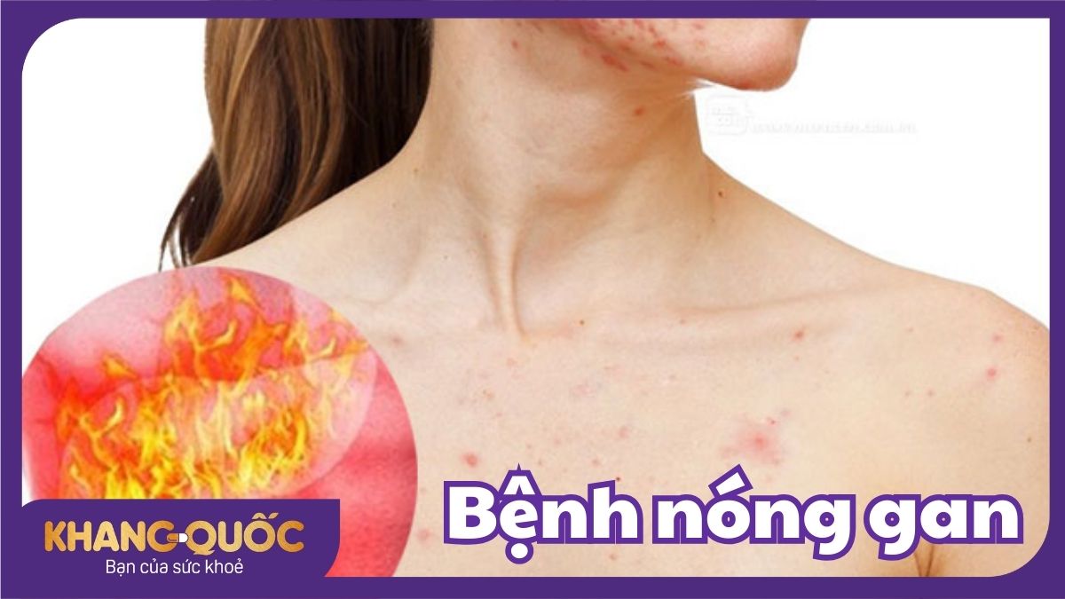 Bệnh nóng gan: Nguyên nhân, triệu chứng, điều trị và phòng ngừa