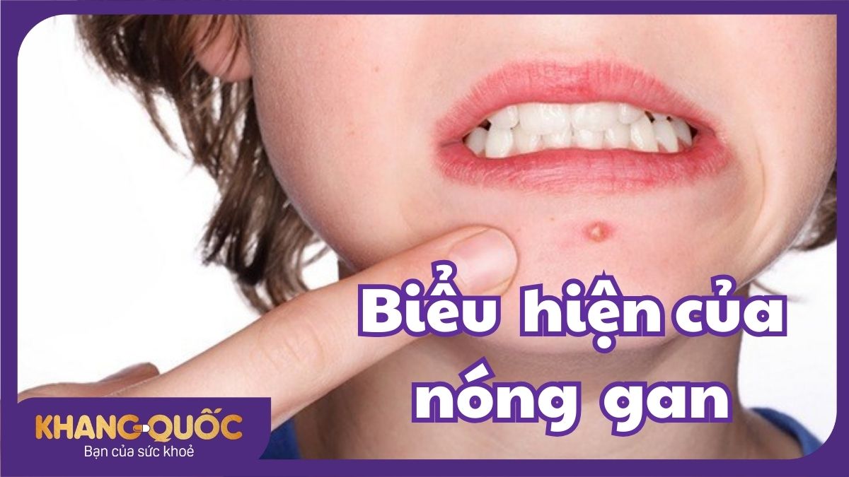 Biểu hiện của nóng gan - 9 dấu hiệu bạn không nên bỏ qua