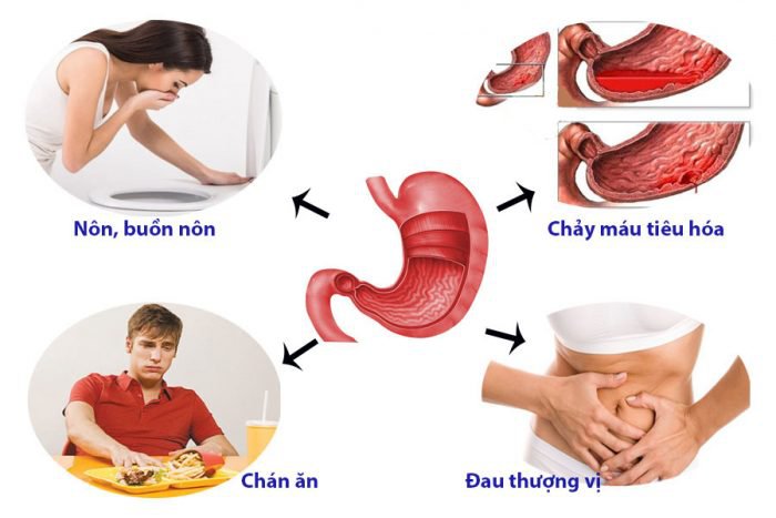 Biểu hiện của đau dạ dày