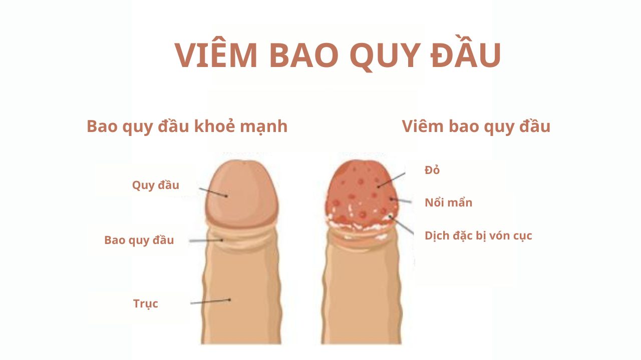 Tiểu đường có thể gây ra viêm bao quy đầu ở nam giới