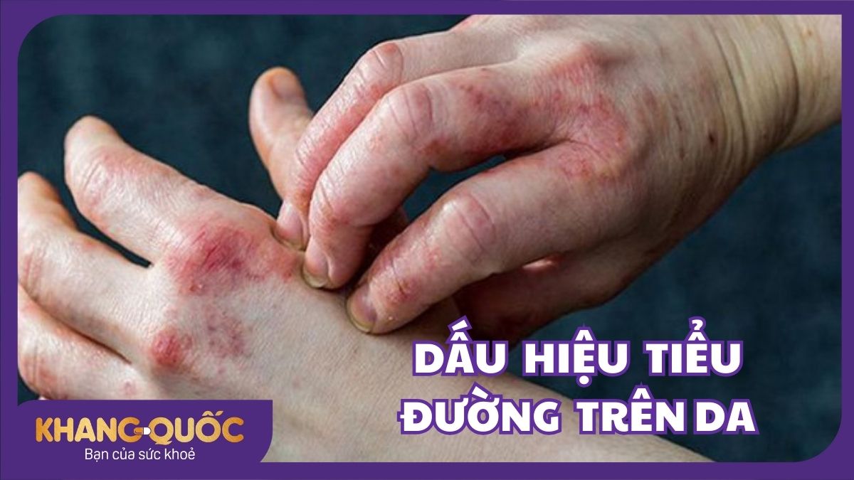 Dấu hiệu tiểu đường trên da không nên coi thường