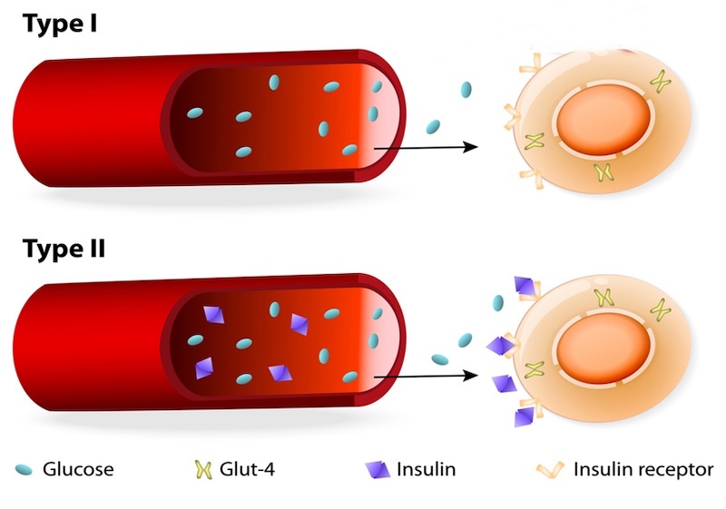 Bệnh tiểu đường tuýp 1, 2 