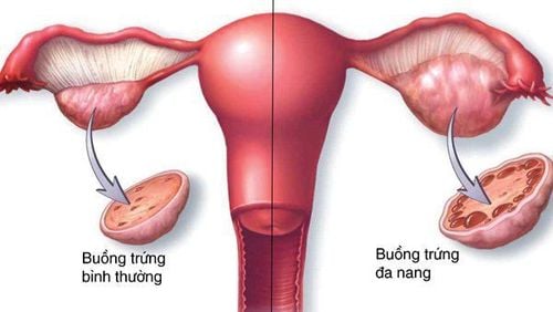 Hội chứng buồng trứng đa nang là một biểu hiện đái tháo đường ở nữ giới