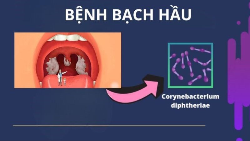 Nguyên nhân gây nên bệnh bạch hầu