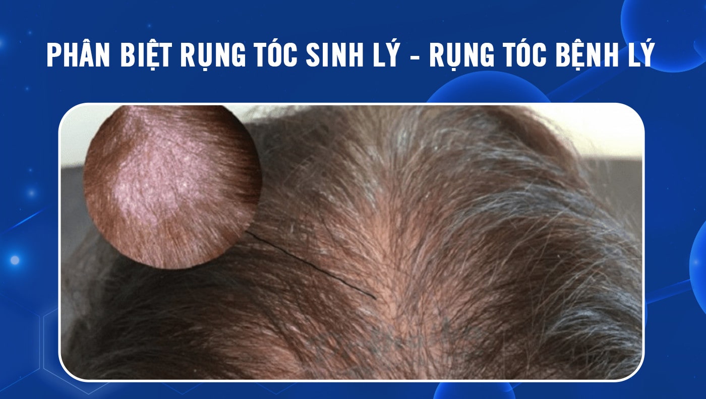 Phân biệt rụng tóc