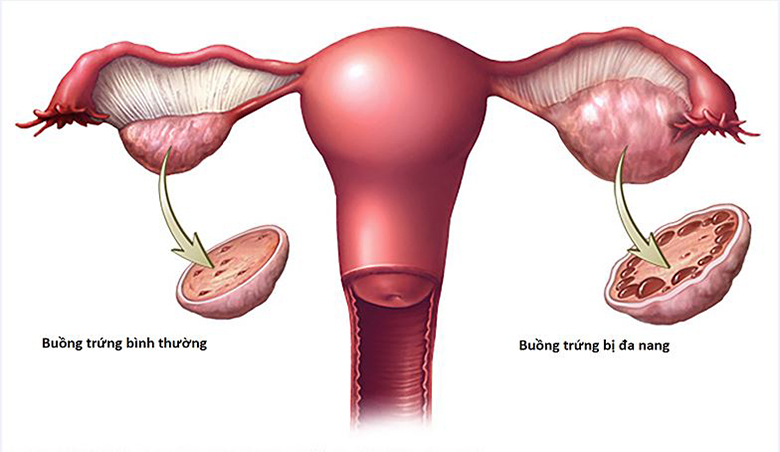 Hội chứng buồng trứng đa nang khiến tóc rụng nhiều