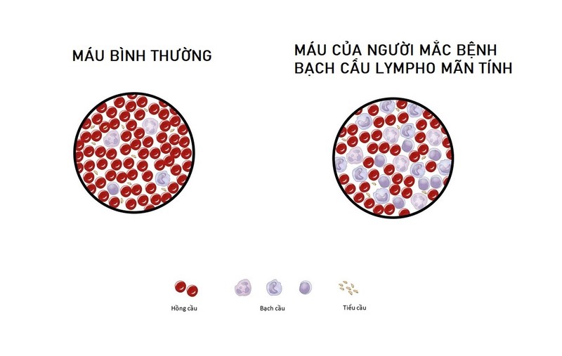 Viêm khớp dạng thấp làm tăng nguy cơ mắc ung thư máu dạng lympho